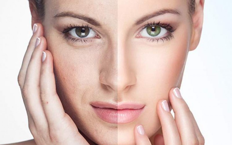 Manchas da Pele | Hiperpigmentação